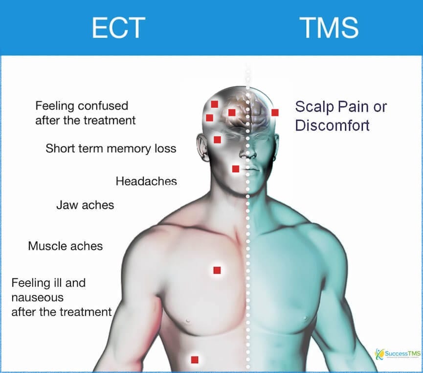 Shock therapy vs TMS therapy